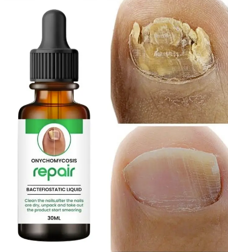 Nail Serum – Complete Nail Protection for Strong, Long & Fungus-Free Nails (Pack of 2)