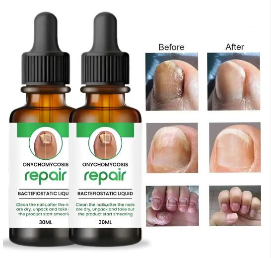 Nail Serum – Complete Nail Protection for Strong, Long & Fungus-Free Nails (Pack of 2)